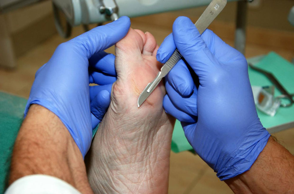 Imagen de una intervención del podólogo para prevenir las amputaciones en el pie diabético.